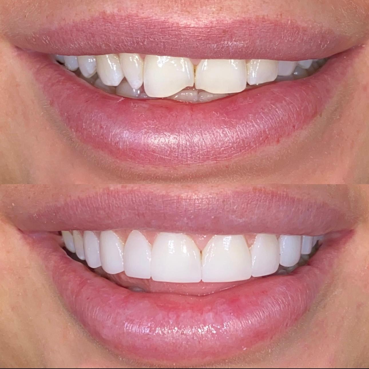 J Bell B&A2Composite Bondingx8